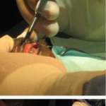 Enucleation - Equine Eye Removal Surgery